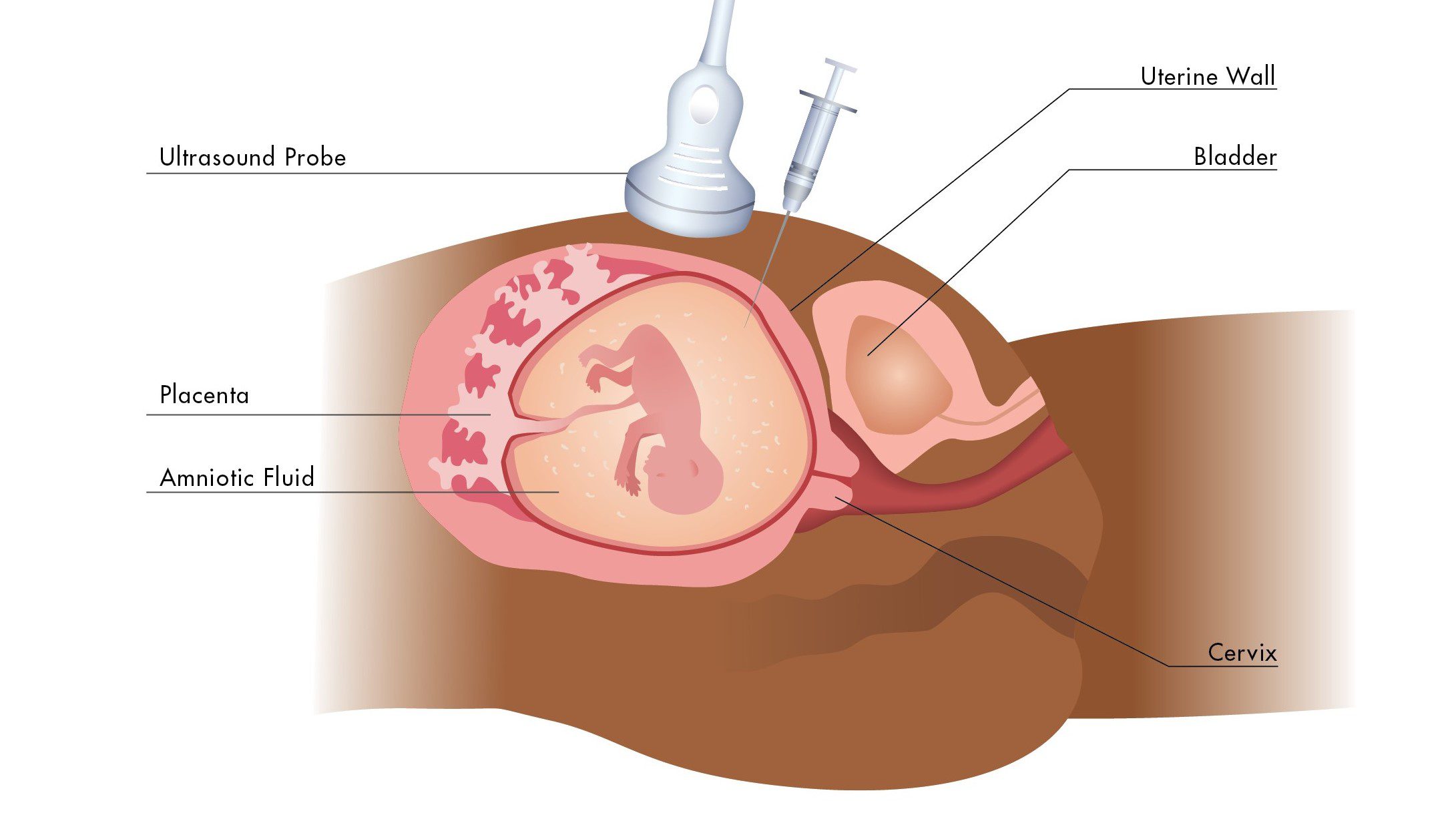 آزمایش آمینوسنتز در دوران بارداری