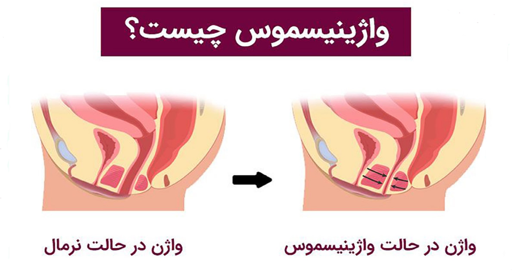 علت بسته شدن واژن هنگام دخول / دخول غیر ممکن / واژینیسموس